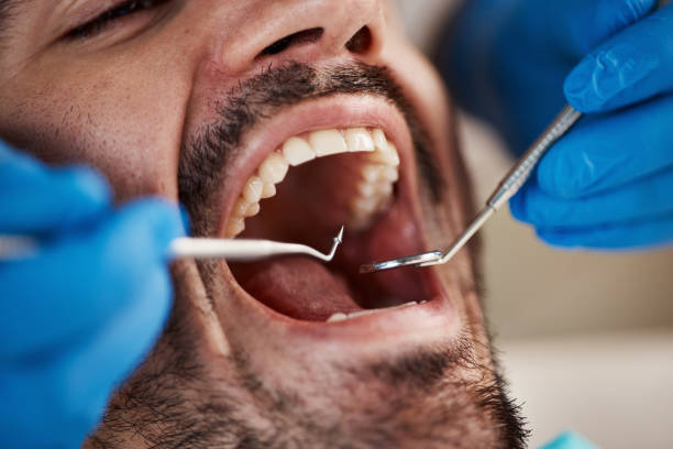 Best Emergency Tooth Extraction in Long Beach, MD